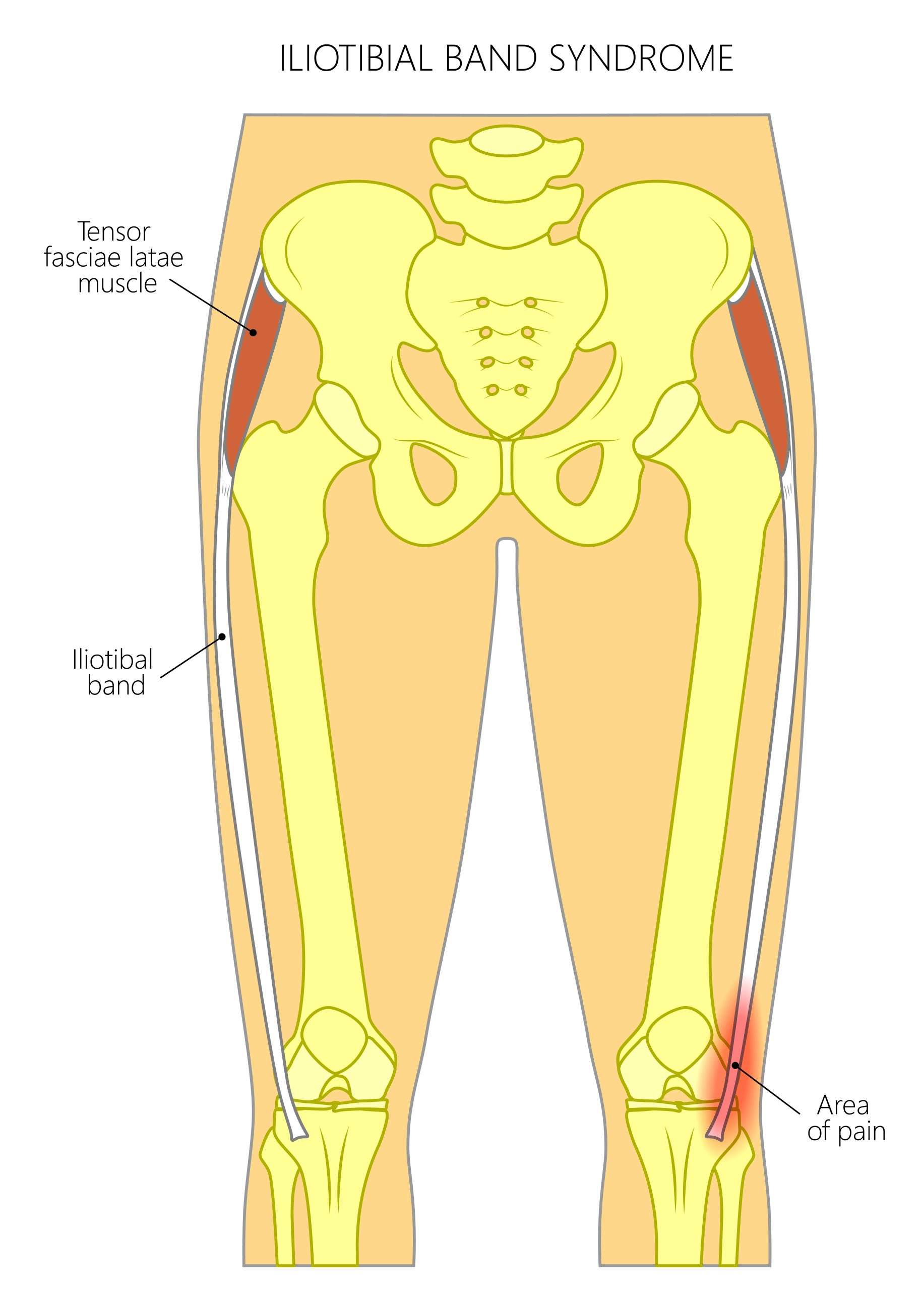 Pain In The Hip Joint Iliotibial Band Syndrome