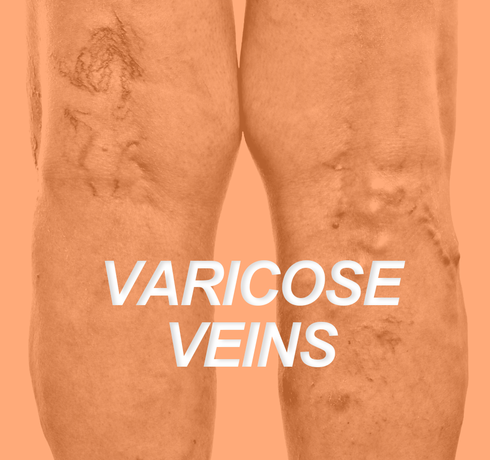 Varicose Veins: Everything Trainers Need To Know