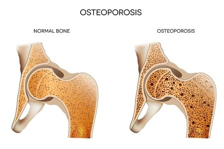 How Personal Trainers Can Help Clients Prevent Osteoporosis 1 bone