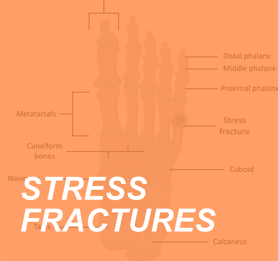 Bone up on Stress Fractures and Prevent the Pain 5 STRESS FRACTURES