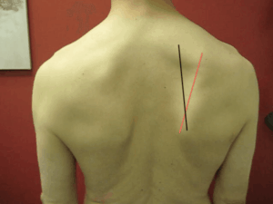 Assessing Scapular Rotation For Pull-Ups 3 ScapularDownwardRotation
