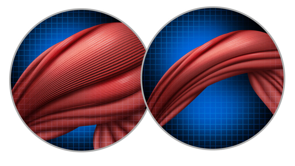 Stop the Slide: Why Losing Muscle on GLP-1s Is the Real Risk 3 iStock 2173838437