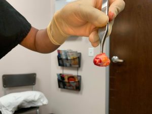 shays cyst 300x225 1