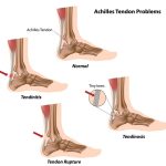 Achilles Tendon Problems