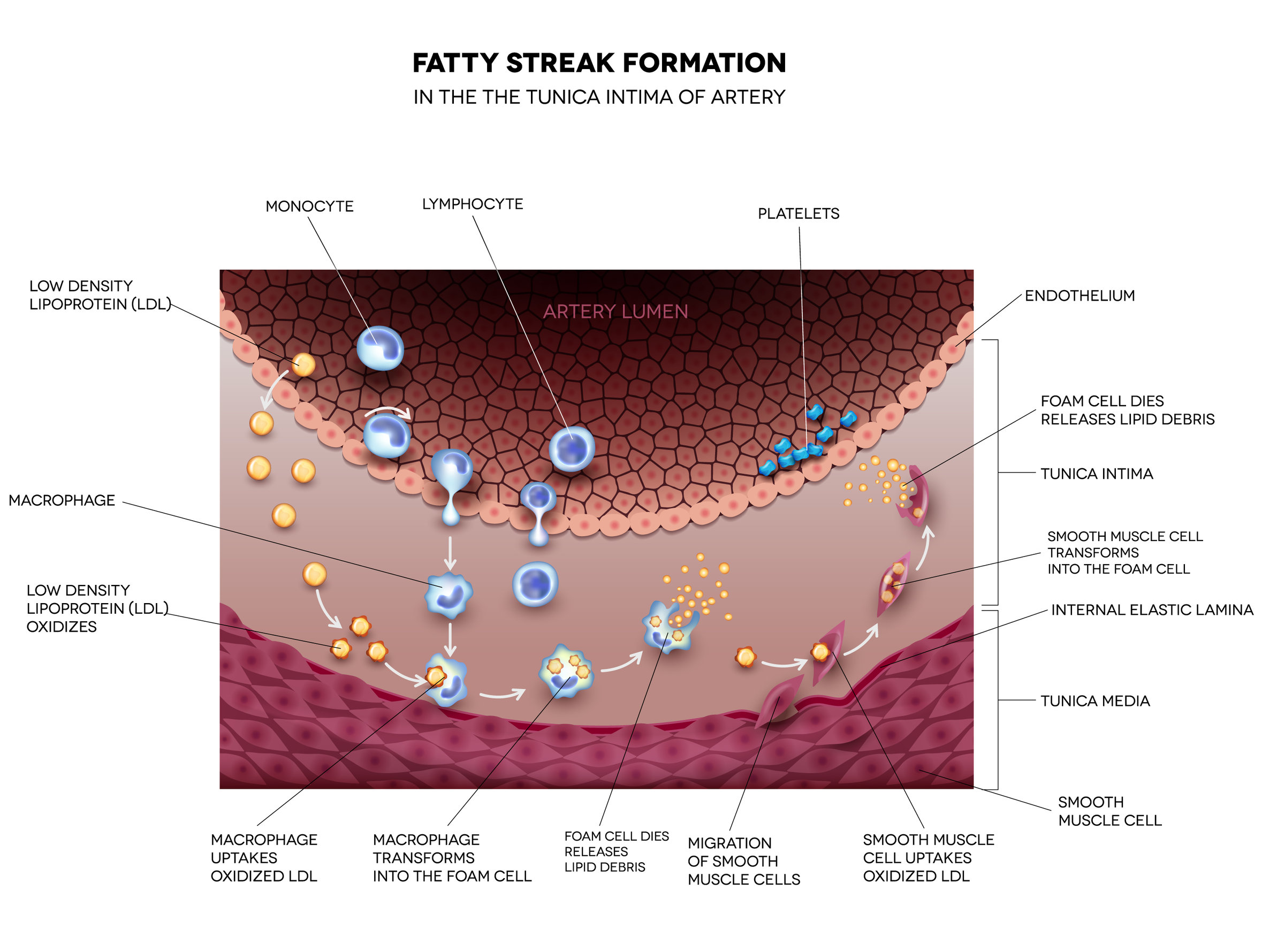 Fatty Streak Formation In The Artery