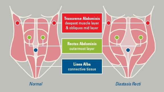 diastasis-recti