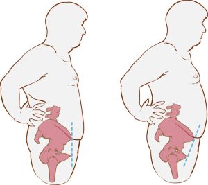 Illustration Of A Forward Hip Tilt